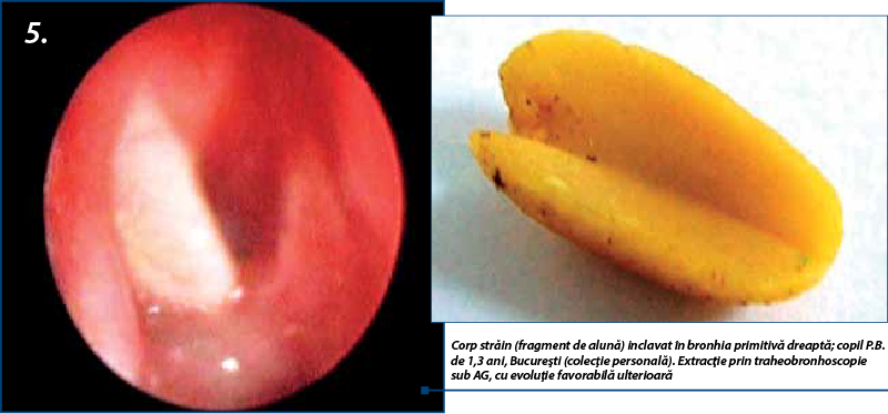 5. Corp străin (fragment de alună) inclavat în bronhia primitivă dreaptă; copil P.B. de 1,3 ani, Bucureşti (colecţie personală). Extracţie prin traheobronhoscopie sub AG, cu evoluţie favorabilă ulterioară