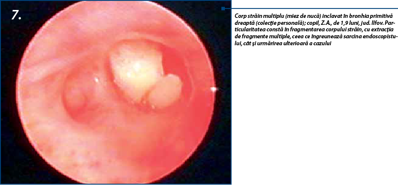 7. Corp străin multiplu (miez de nucă) inclavat în bronhia primitivă dreaptă (colecţie personală); copil, Z.A., de 1,9 luni, jud. Ilfov. Particularitatea constă în fragmentarea corpului străin, cu extracţia de fragmente multiple, ceea ce îngreunează sarcina endoscopistului, cât şi urmărirea ulterioară a cazului