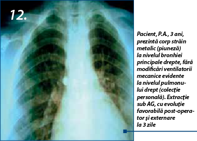 12. Pacient, P.A., 3 ani, prezintă corp străin metalic (piuneză) la nivelul bronhiei principale drepte, fără modificări ventilatorii mecanice evidente la nivelul pulmonului drept (colecţie personală). Extracţie sub AG, cu evoluţie favorabilă post-operator şi externare  la 3 zile