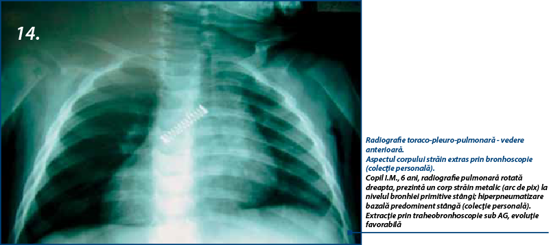 14. Radiografie toraco-pleuro-pulmonară - vedere anterioară.  Aspectul corpului străin extras prin bronhoscopie (colecţie personală). Copil I.M., 6 ani, radiografie pulmonară rotată dreapta, prezintă un corp străin metalic (arc de pix) la nivelul bronhiei primitive stângi; hiperpneumatizare bazală predominent stângă (colecţie personală). Extracţie prin traheobronhoscopie sub AG, evoluţie favorabilă