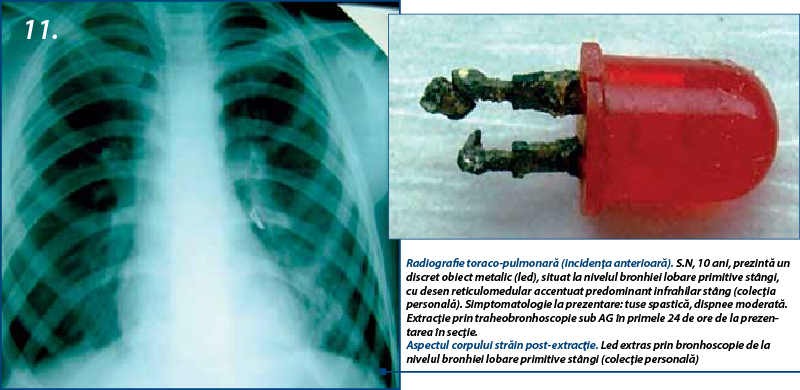 11. Radiografie toraco-pulmonară (incidenţa anterioară). S.N, 10 ani, prezintă un discret obiect metalic (led), situat la nivelul bronhiei lobare primitive stângi, cu desen reticulomedular accentuat predominant infrahilar stâng (colecţia personală). Simptomatologie la prezentare: tuse spastică, dispnee moderată. Extracţie prin traheobronhoscopie sub AG în primele 24 de ore de la prezentarea în secţie.  Aspectul corpului străin post-extracţie. Led extras prin bronhoscopie de la nivelul bronhiei lobare primitive stângi (colecţie personală)