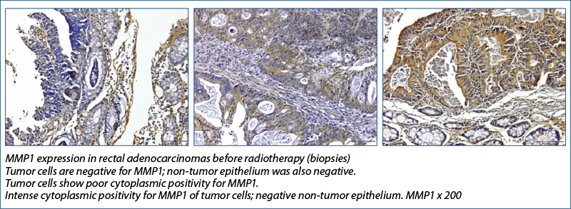 MMP1 expression in rectal adenocarcinomas before radiotherapy (biopsies)