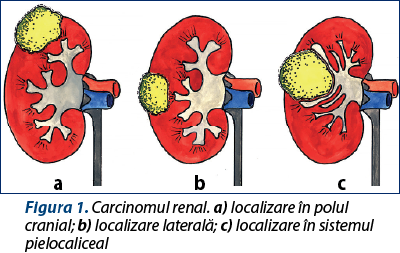 Figura 1. Carcinomul renal. a) localizare în polul cranial; b) localizare laterală; c) localizare în sistemul pielocaliceal