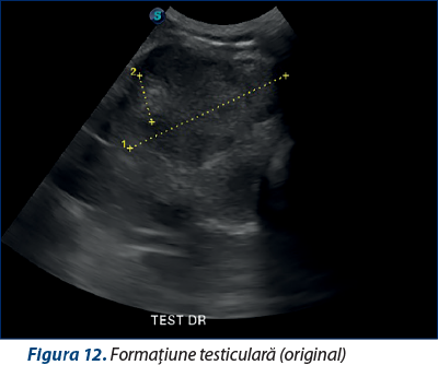 Figura 12. Formaţiune testiculară (original)