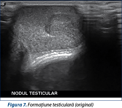 Figura 7. Formaţiune testiculară (original)