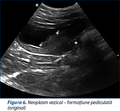 Figura 6. Neoplasm vezical – formaţiune pediculată (original)