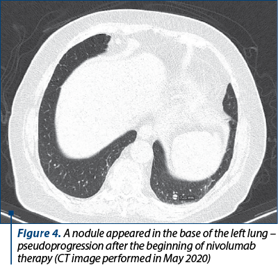 Figure 4. A nodule appeared in the base of the left lung –  pseudoprogression after the beginning of nivolumab therapy (CT image performed in May 2020)