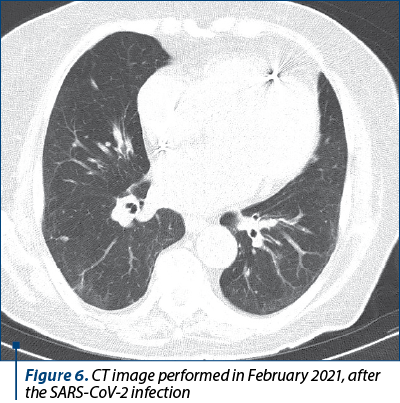 Figure 6. CT image performed in February 2021, after the SARS-CoV-2 infection