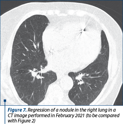 Figure 7. Regression of a nodule in the right lung in a CT image performed in February 2021 (to be compared with Figure 2)