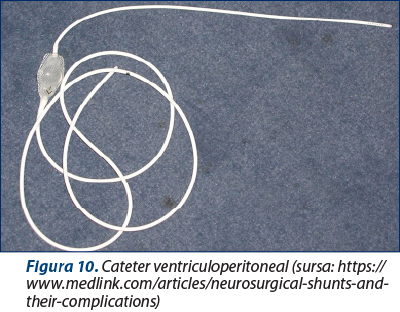 Figura 10. Cateter ventriculoperitoneal (sursa: https://www.medlink.com/articles/neurosurgical-shunts-and-their-complications)
