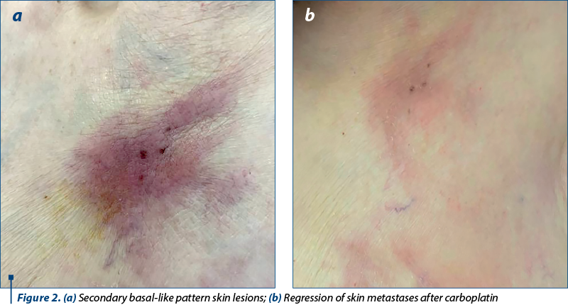 Figure 2. (a) Secondary basal-like pattern skin lesions; (b) Regression of skin metastases after carboplatin 