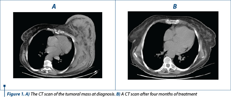 Figure 1. A) The CT scan of the tumoral mass at diagnosis. B) A CT scan after four months of treatment 