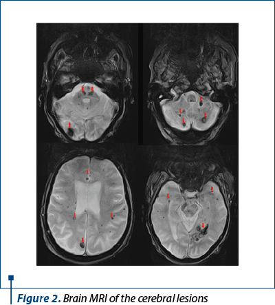 Figure 2. Brain MRI of the cerebral lesions