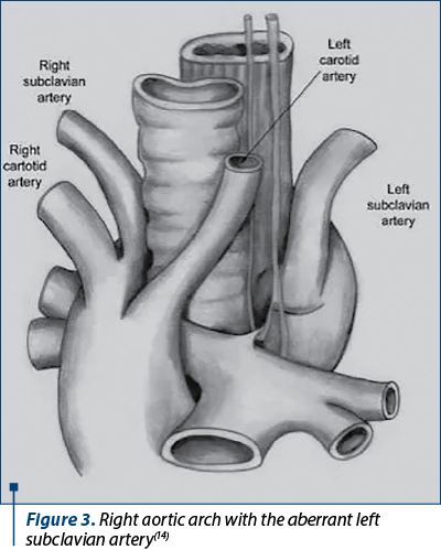 Figure 3. Right aortic arch with the aberrant left subclavian artery(14)