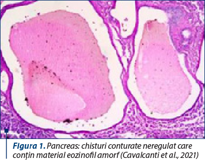 Figura 1. Pancreas: chisturi conturate neregulat care conţin material eozinofil amorf (Cavalcanti et al., 2021)