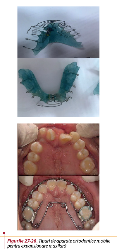 Figurile 27-28. Tipuri de aparate ortodontice mobile pentru expansionare maxilară