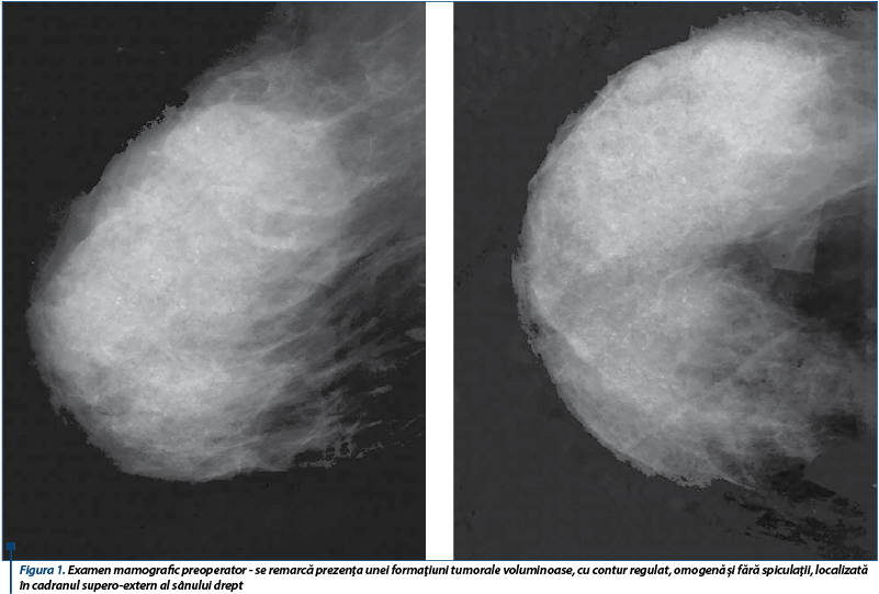 Figura 1. Examen mamografic preoperator - se remarcă prezenţa unei formaţiuni tumorale voluminoase, 