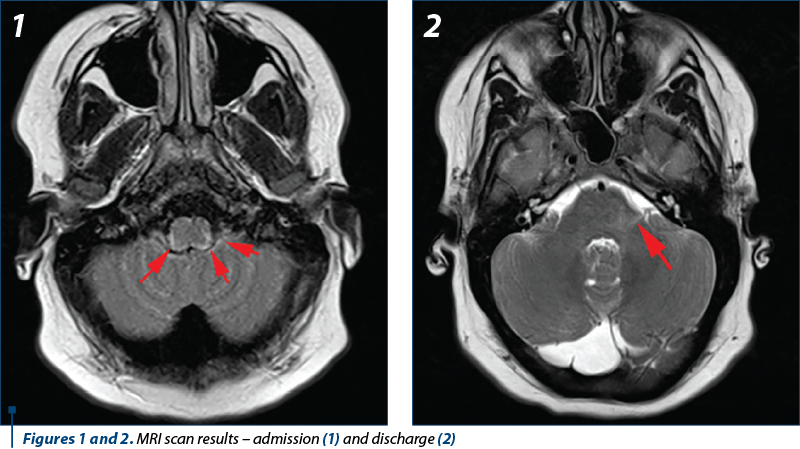 Figures 1 and 2. MRI scan results – admission (1) and discharge (2)