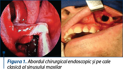 Figura 1. Abordul chirurgical endoscopic şi pe cale clasică al sinusului maxilar