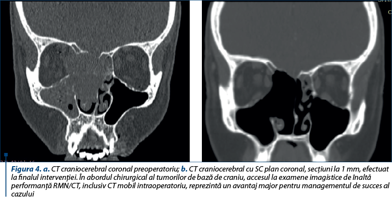 Figura 4. a. CT craniocerebral coronal preoperatoriu; b. CT craniocerebral cu SC plan coronal, secţiuni la 1 mm, efectuat la finalul intervenţiei. În abordul chirurgical al tumorilor de bază de craniu, accesul la examene imagistice de înaltă performanţă RMN/CT, inclusiv CT mobil intraoperatoriu, reprezintă un avantaj major pentru managementul de succes al cazului