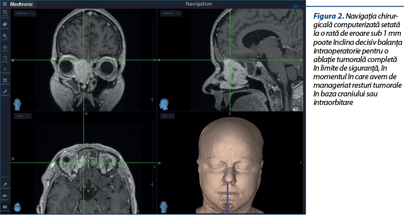 Figura 2. Navigaţia chi­rur­gicală computerizată setată la o rată de eroa­re sub 1 mm poate înclina decisiv balanţa intraoperatorie pentru o ablaţie tumorală completă în limite de siguranţă, în momentul în care avem de manageriat resturi tumorale în baza craniului sau intraorbitare