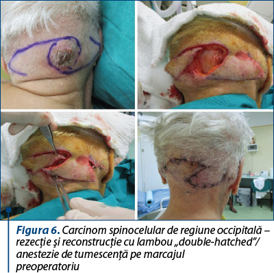 Figura 6. Carcinom spinocelular de regiune occipitală – rezecţie şi reconstrucţie cu lambou „double-