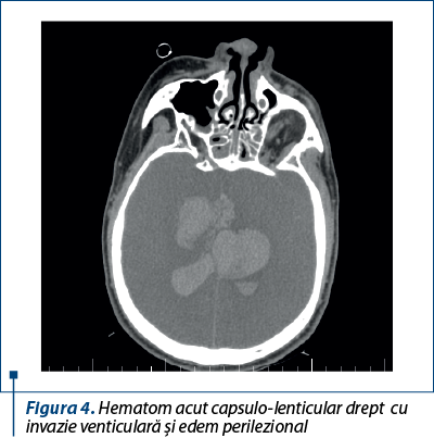 Figura 4. Hematom acut capsulo-lenticular drept  cu invazie venticulară şi edem perilezional