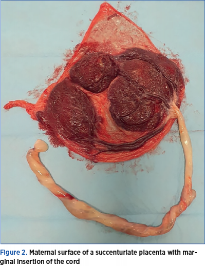 Figure 2. Maternal surface of a succenturiate placenta with marginal insertion of the cord