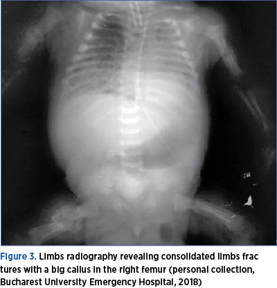 Figure 3. Limbs radiography revealing consolidated limbs fractures with a big callus in the right femur (personal collection, Bucharest University Emergency Hospital, 2018)