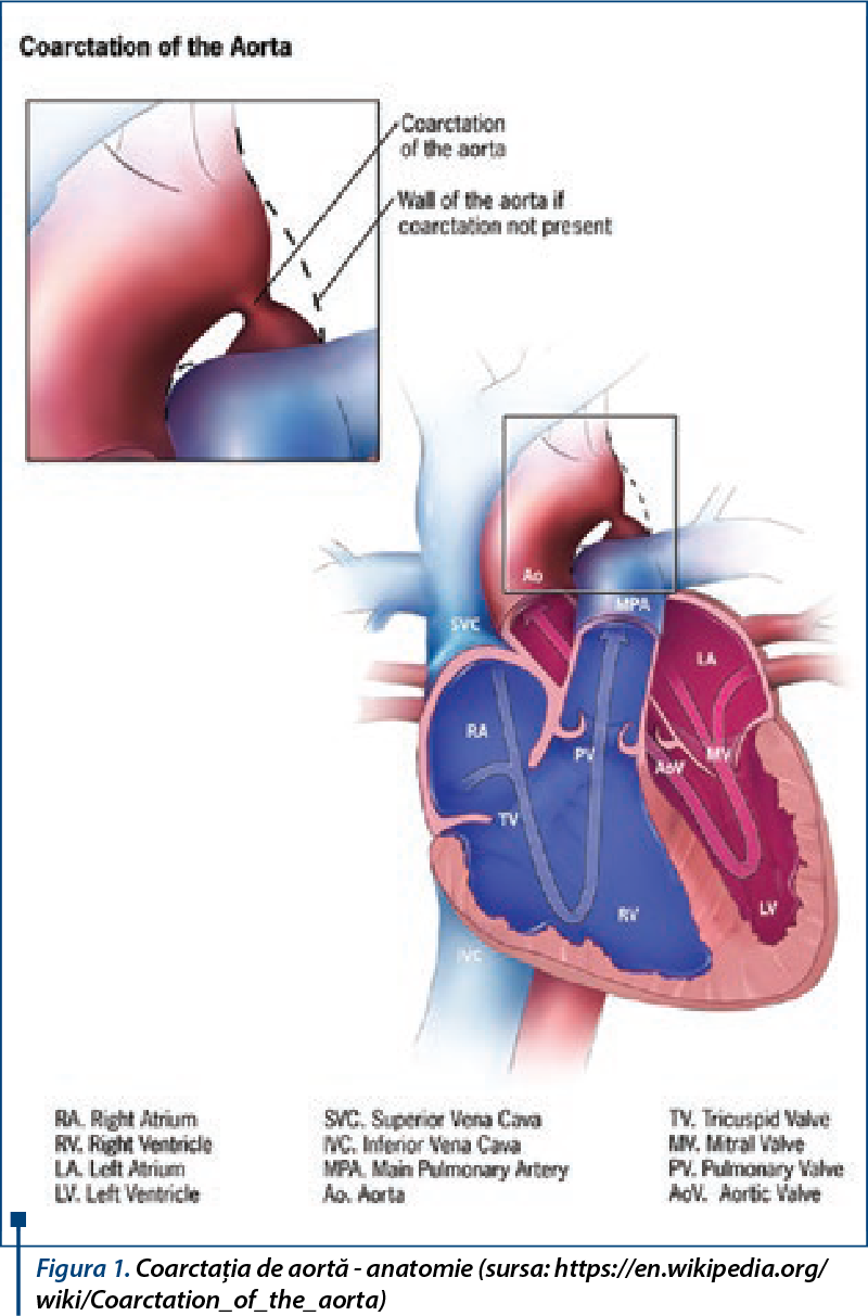 Figura 1. Coarctaţia de aortă - anatomie