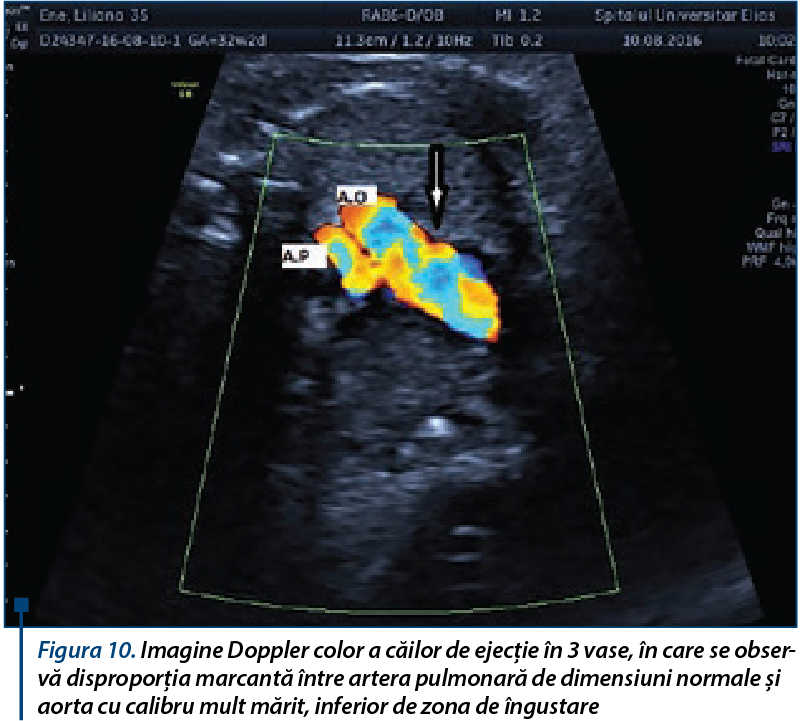 Figura 10. Imagine Doppler color a căilor de ejecţie în 3 vase, în care se observă disproporţia marcantă între artera pulmonară de dimensiuni normale şi aorta cu calibru mult mărit, inferior de zona de îngust