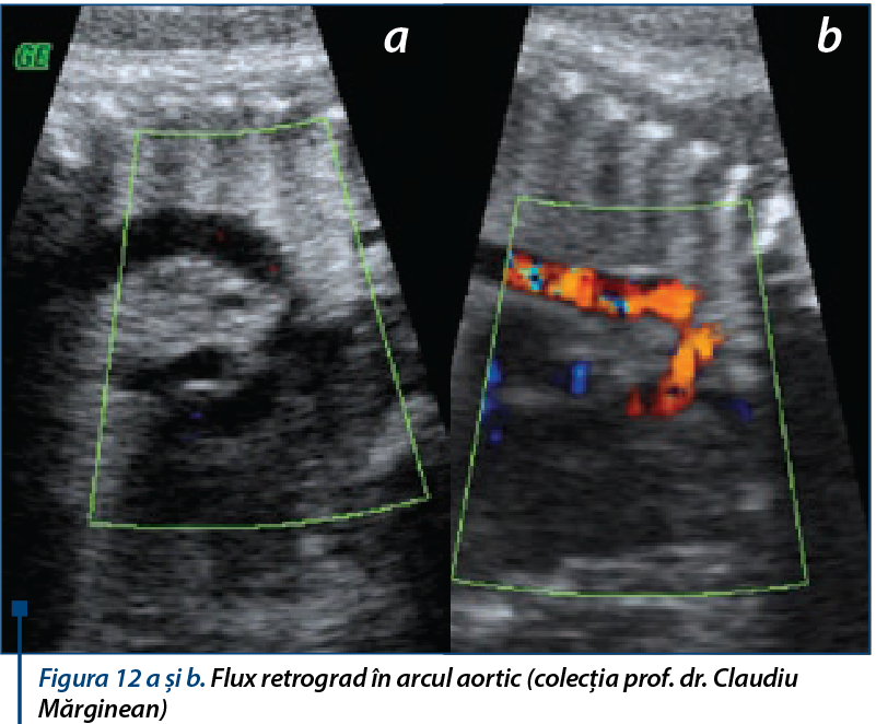 Figura 12 a şi b. Flux retrograd în arcul aortic (colecţia prof. dr. Claudiu Mărginean)