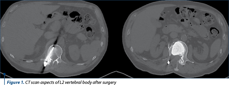 Figure 1. CT scan aspects of L2 vertebral body after surgery