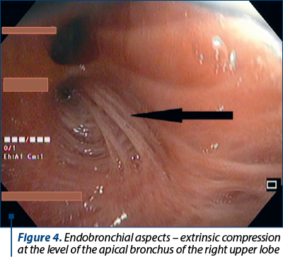 Figure 4. Endobronchial aspects – extrinsic compres­sion at the level of the apical bronchus of the right upper lobe