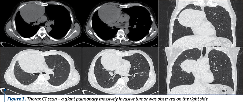 Figure 3. Thorax CT scan – a giant pulmonary massively invasive tumor was observed on the right side