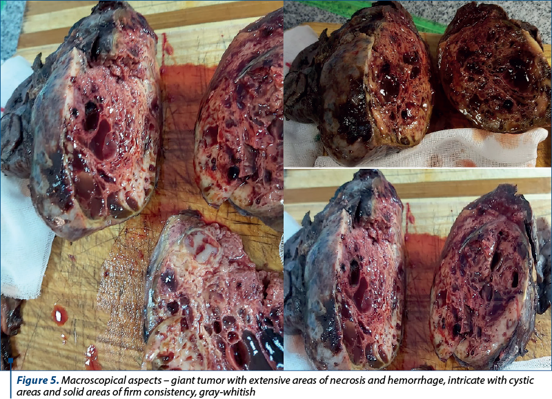 Figure 5. Macroscopical aspects – giant tumor with extensive areas of necrosis and hemorrhage, intricate with cystic areas and solid areas of firm consistency, gray-whitish
