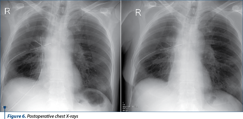 Figure 6. Postoperative chest X-rays