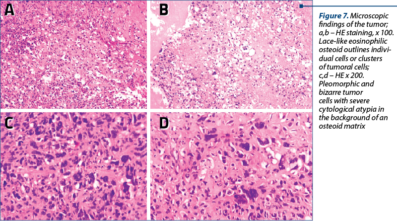 Figure 7. Microscopic findings of the tumor; a,b – HE staining, x 100. Lace-like eosinophilic osteoid outlines in­di­vi­dual cells or clusters  of tumoral cells;  c,d – HE x 200. Pleomorphic and bizarre tumor cells with severe cytological atypia in the background of an osteoid matrix