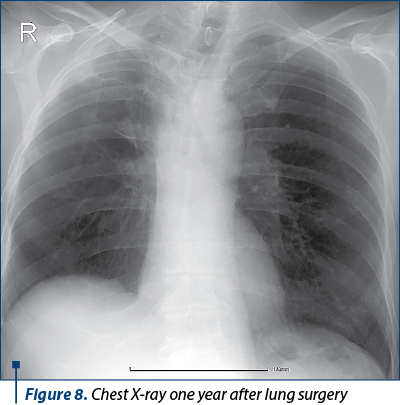 Figure 8. Chest X-ray one year after lung surgery