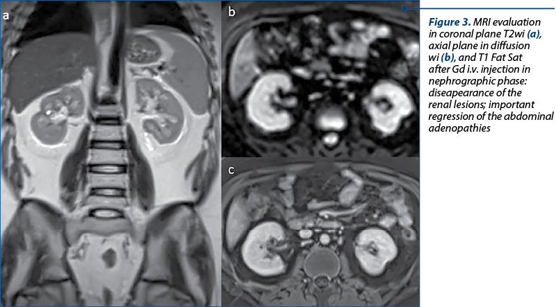 Figure 3. MRI evaluation in coronal plane T2wi (a), axial plane in diffusion wi (b), and T1 Fat Sat after Gd i.v. injection in nephrographic phase: diseapearance of the renal lesions; important regression of the abdominal adenopathies