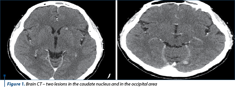 Figure 1. Brain CT – two lesions in the caudate nucleus and in the occipital area