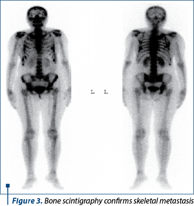 Figure 3. Bone scintigraphy confirms skeletal metastasis