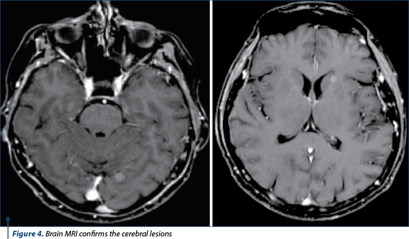 Figure 4. Brain MRI confirms the cerebral lesions