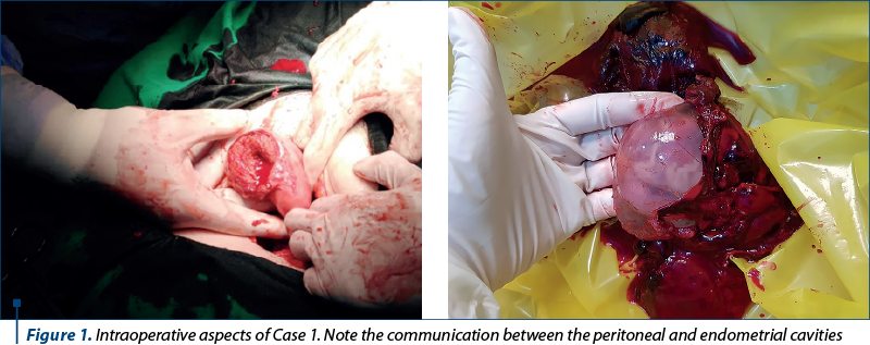 Figure 1. Intraoperative aspects of Case 1. Note the communication between the peritoneal and endometrial cavities  