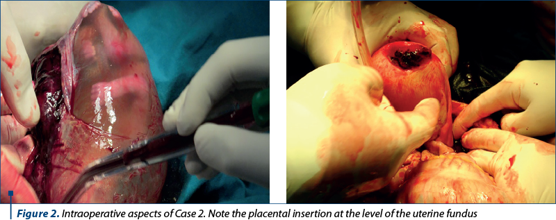 Figure 2. Intraoperative aspects of Case 2. Note the placental insertion at the level of the uterine fundus 