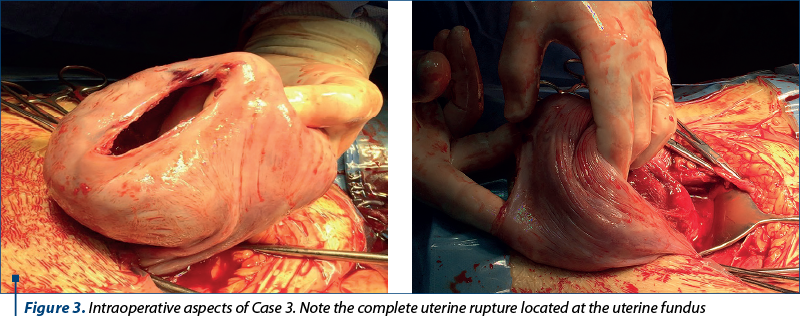 Figure 3. Intraoperative aspects of Case 3. Note the complete uterine rupture located at the uterine fundus