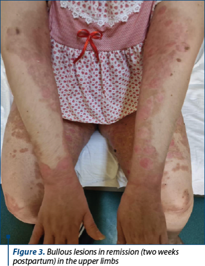 Figure 3. Bullous lesions in remission (two weeks postpartum) in the upper limbs
