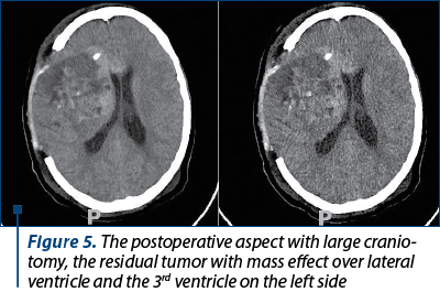 Figure 5. The postoperative aspect with large cranio­tomy, the residual tumor with mass effect over lateral ventricle and the 3rd ventricle on the left side