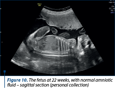 Figure 9. The fetus at 22 weeks, with normal amniotic fluid (personal collection)
