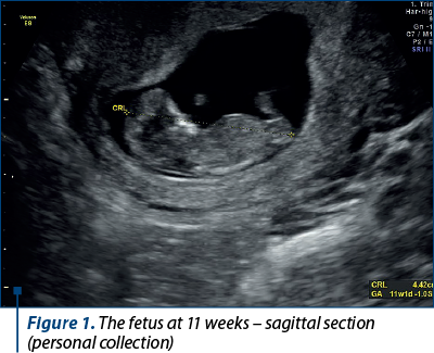 Figure 1. The fetus at 11 weeks – sagittal section (personal collection)